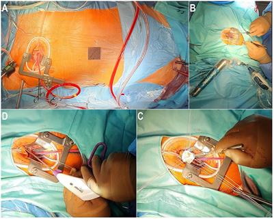 Lessons learned from 10 years of experience with minimally invasive cardiac surgery